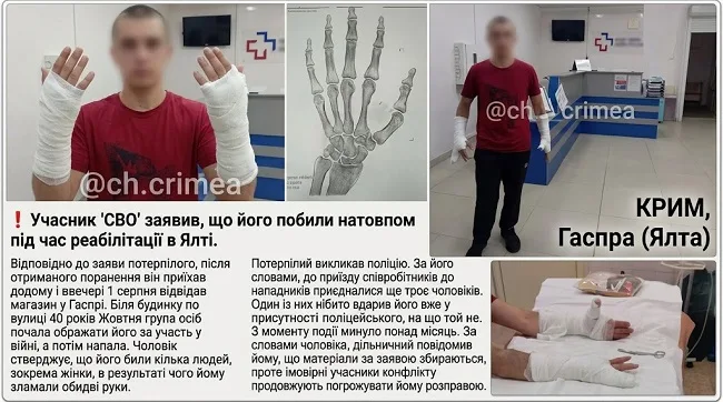 «рашисту, який воював за росію, отримав поранення та лікувався в Ялті, кримчани зламали руки та пояснили, що таке зло»
