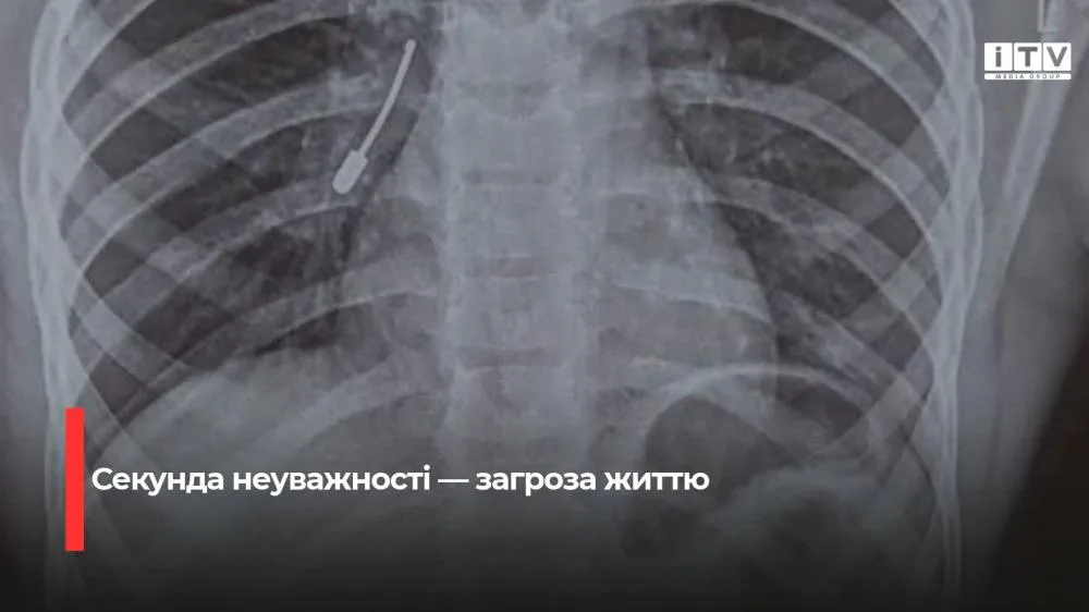 У Рівному хірурги витягли з дихальних шляхів дитини деталь від електричної вилки