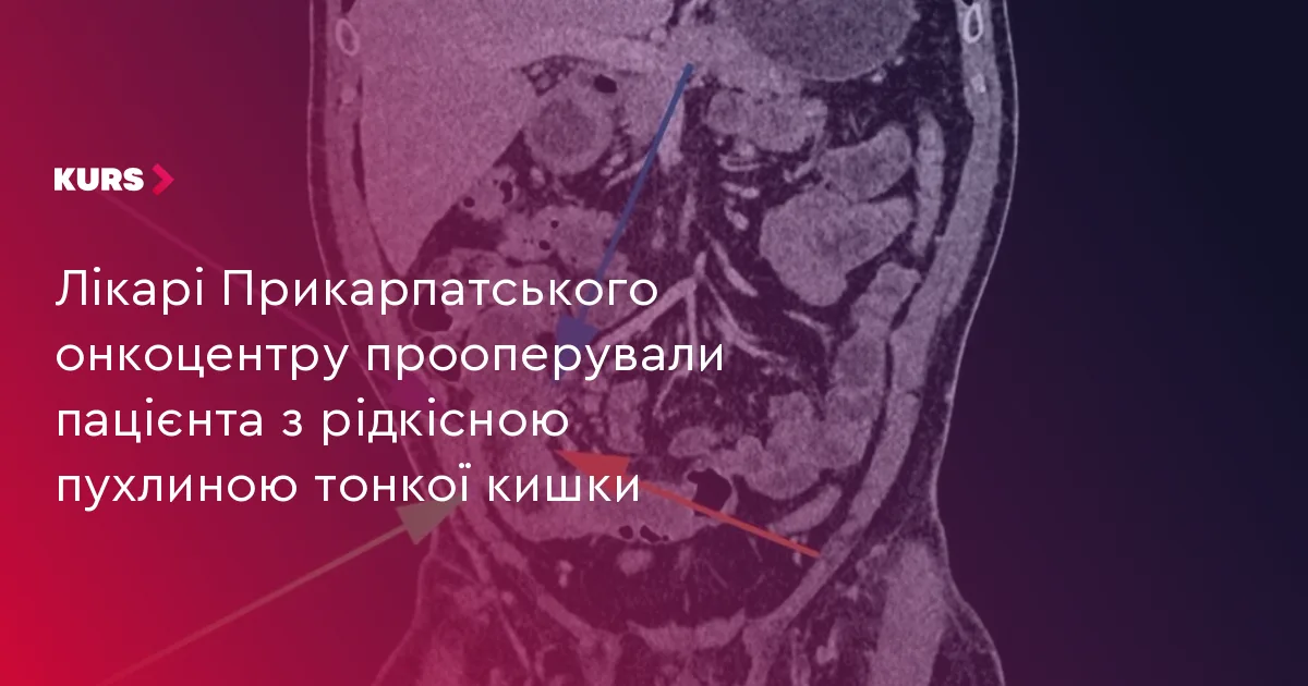 Лікарі Прикарпатського онкоцентру прооперували пацієнта з рідкісною пухлиною тонкої кишки