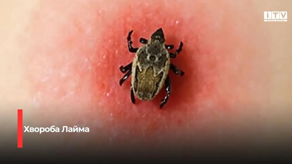 У жителя Рівненщини виявили хворобу Лайма