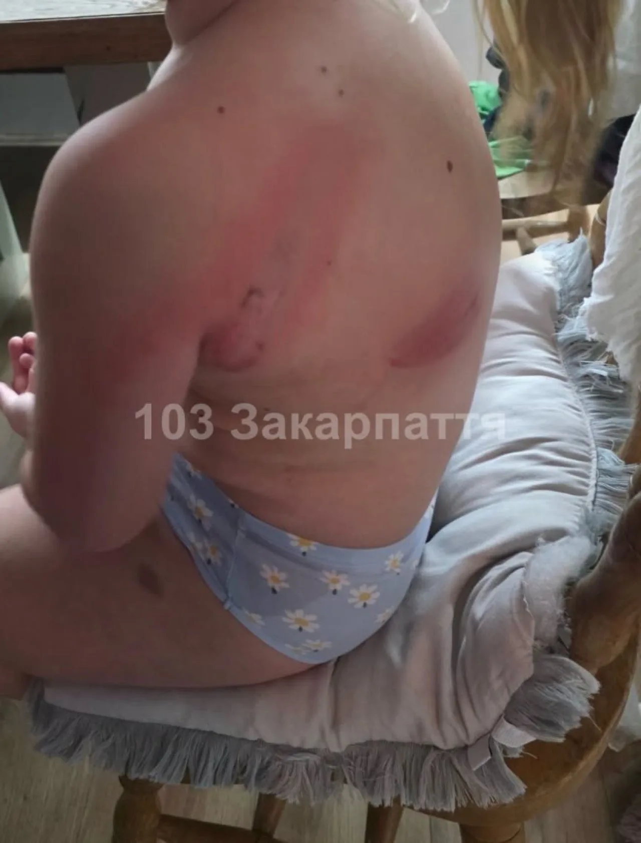 На Мукачівщині 7-річна дитина впала на піч та отримала опіки спини й плеча