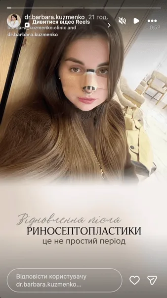 Барбара Кузьменко сделала риносептопластику
